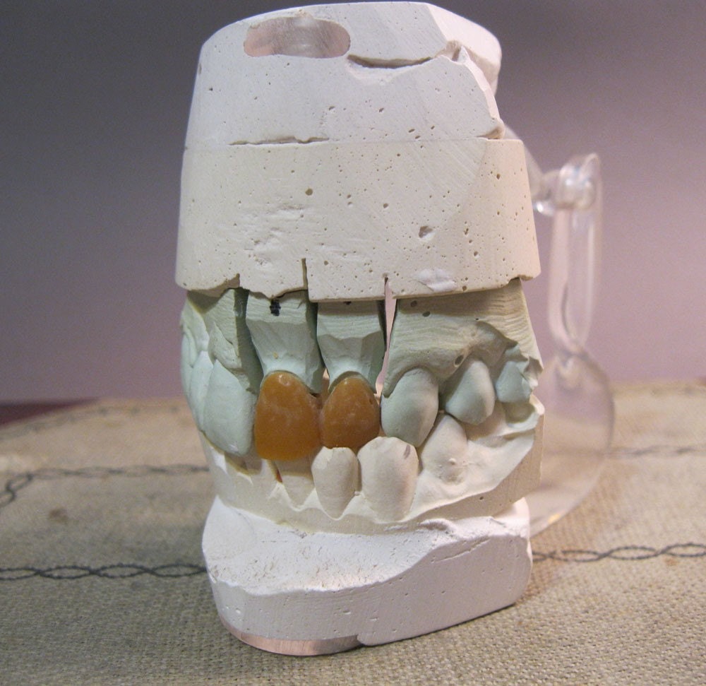 SALE - vintage DENTAL model - upper and lower teeth, hinged, articulated, jaw, implant, post, bridge, caps - BiTE ME - oddities