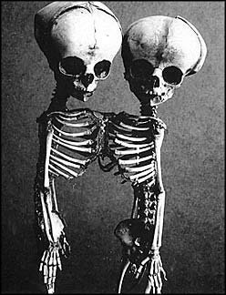 Conjoined Twins Siamese Fetal Skeletons, made to order.