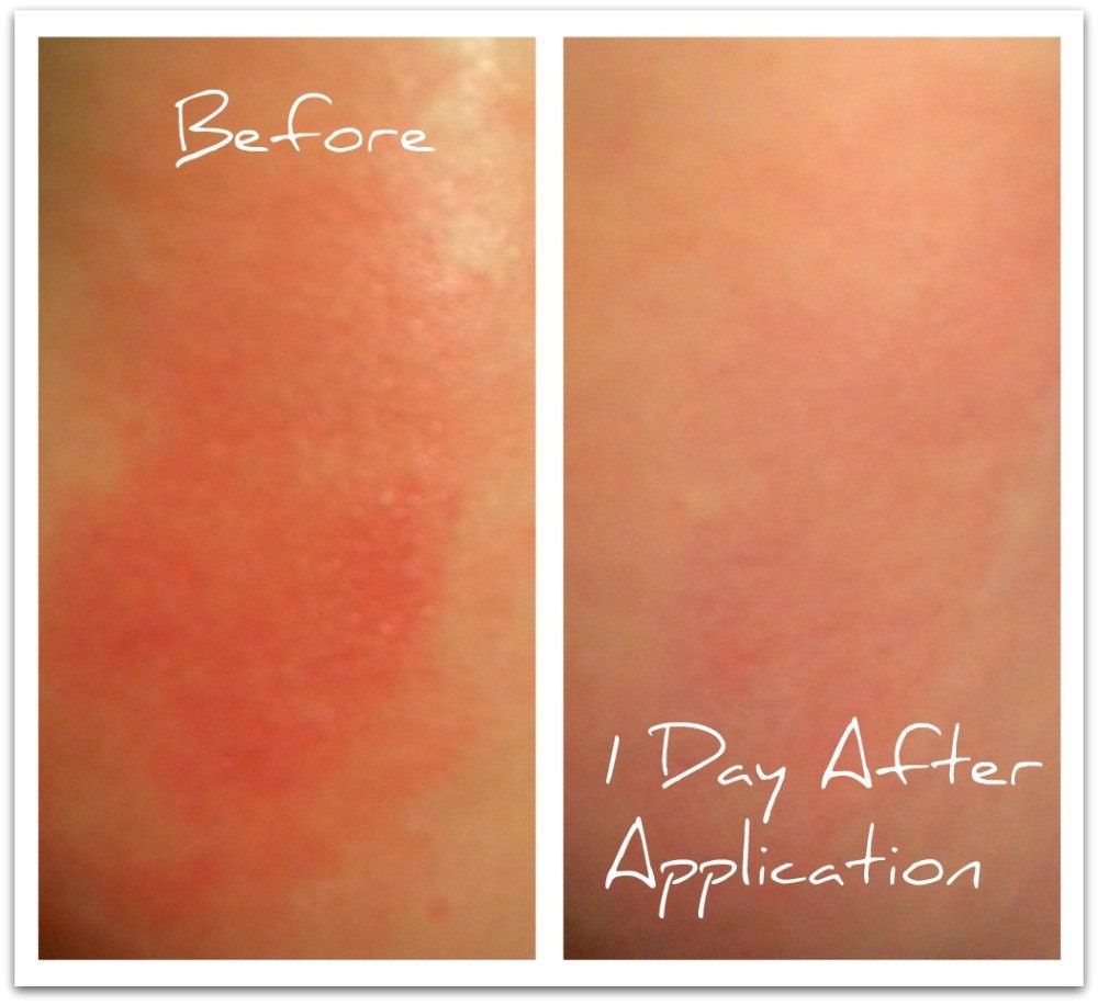 Dry Skin Eczema Cream--Organic Natural Intense Healing Lotion for Eczema, Dermatitis, Dry and Chapped Skin-- Almond or Vanilla Orange