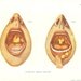 1920s Antique Colour Medical Print "Syphilitic Throat Disease " Ideal for Framing.