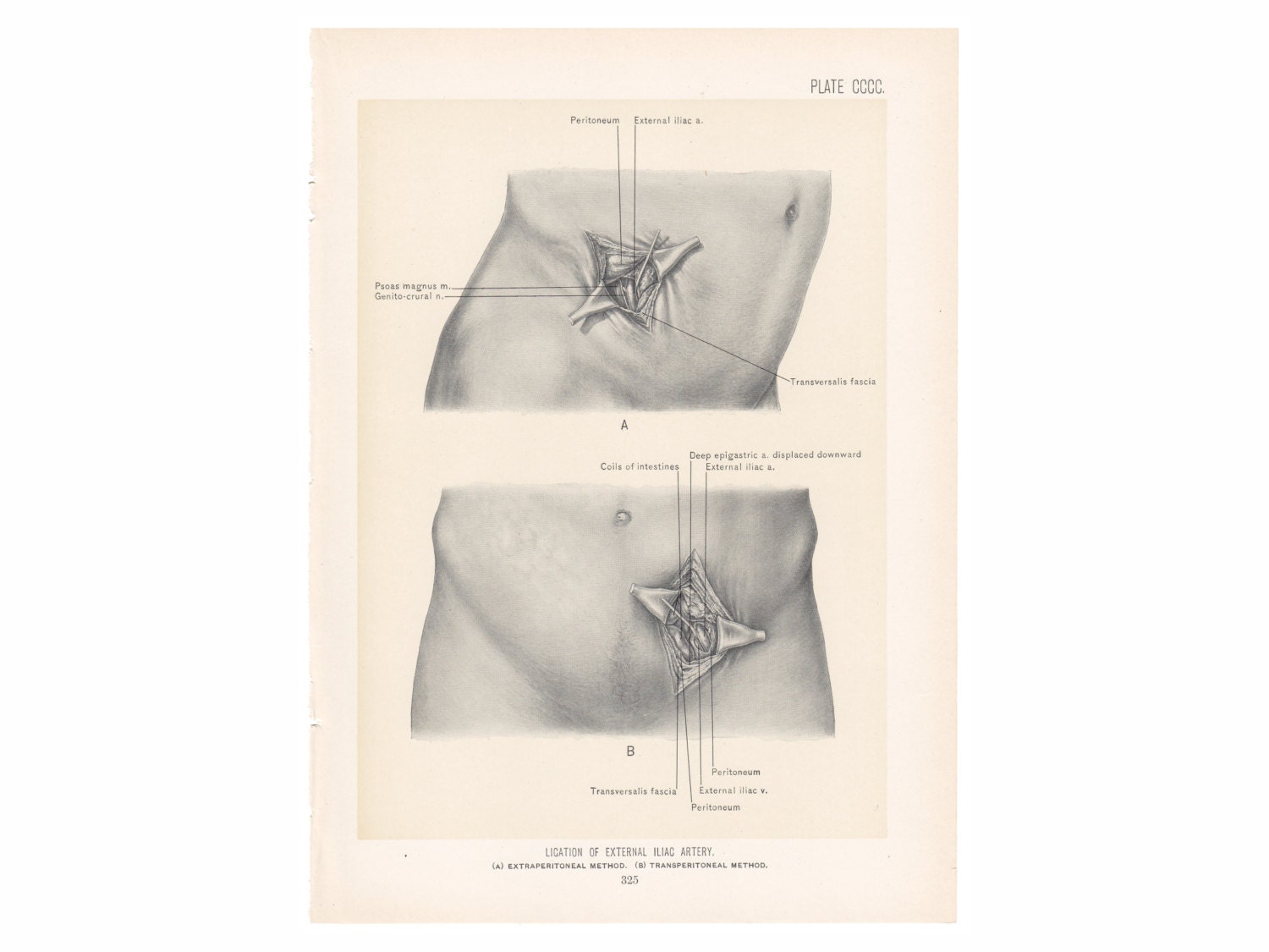Antique LIGATION of External ILIAC ARTERY Surgical Anatomy Illustration
