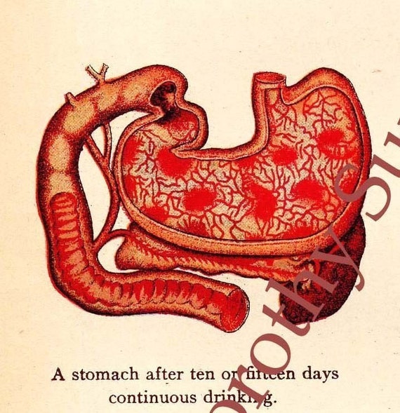 Effects Of Alcohol On The Stomach 1908 Antique Human Anatomy