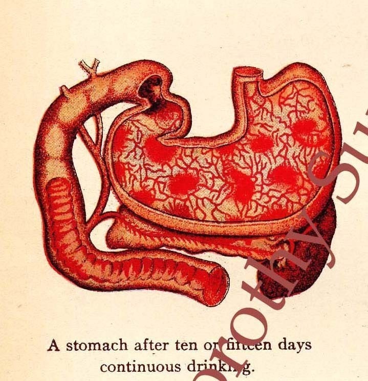 Effects Of Alcohol On The Stomach 1908 Antique by SurrenderDorothy