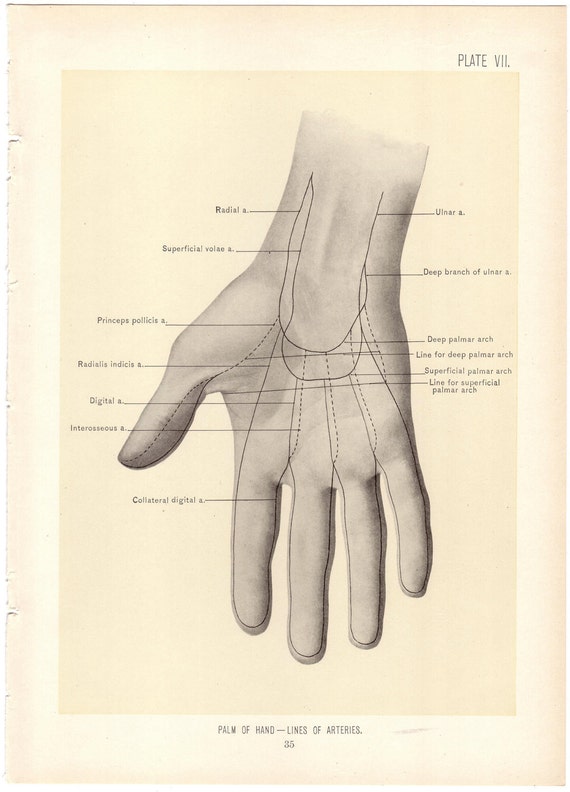 1899 Antique PALM OF HAND Surgical Anatomy Illustration