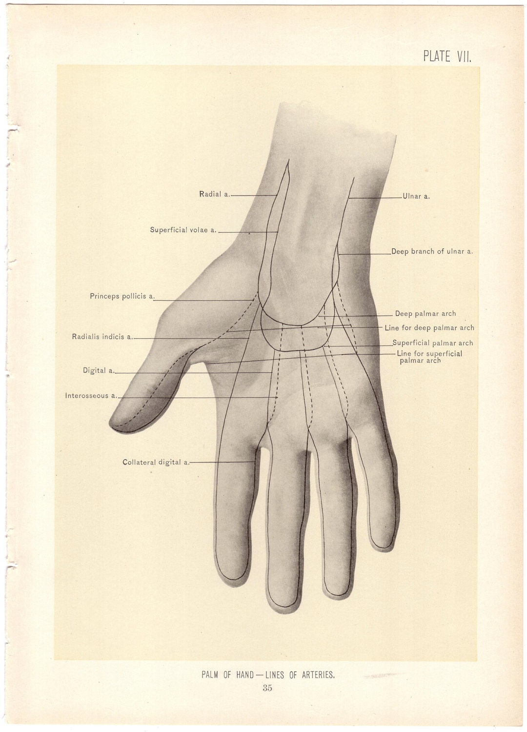 1899 Antique PALM OF HAND Surgical Anatomy Illustration