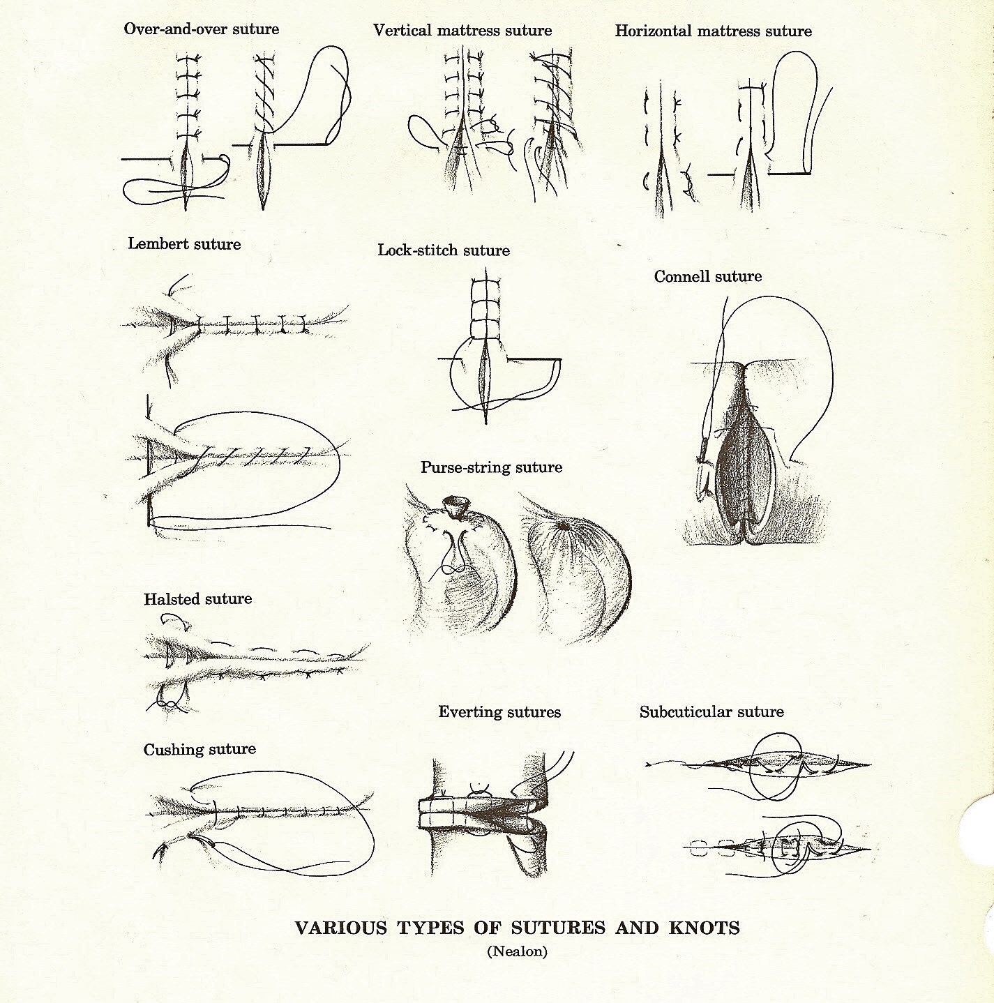 Vintage Medical Anatomy Illustration of Sutures and Knots