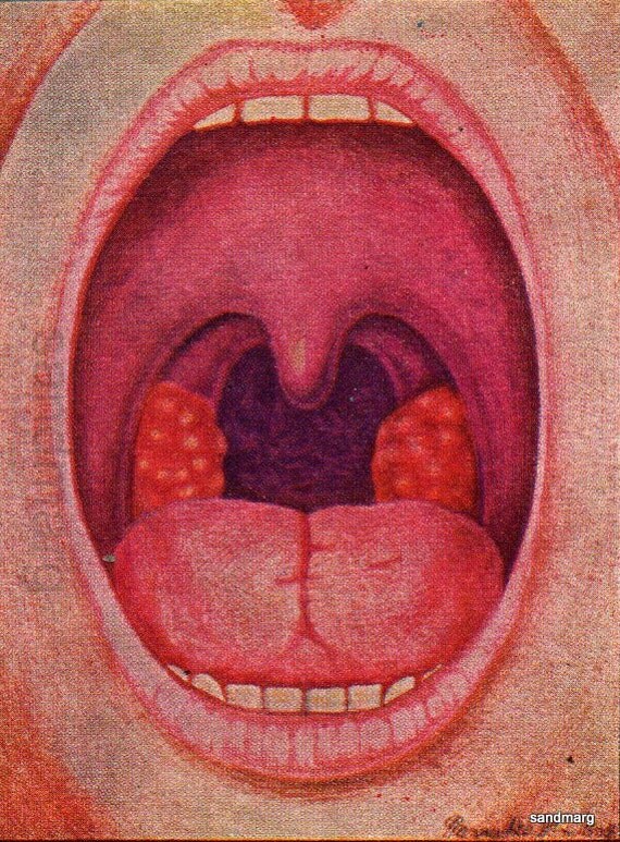 Vintage 1944 Medical Illustration Tonsillitis