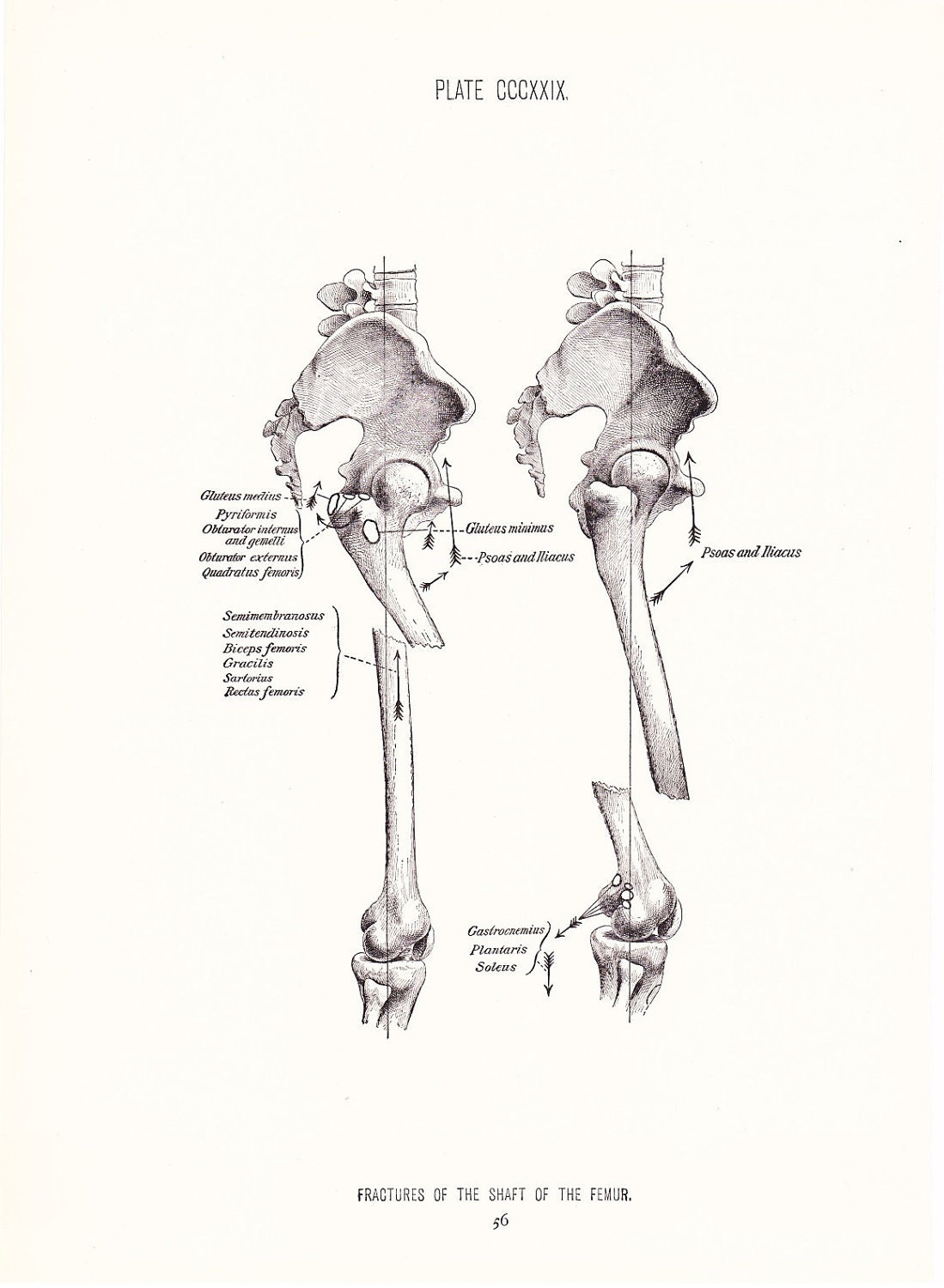 Broken Leg Diagram