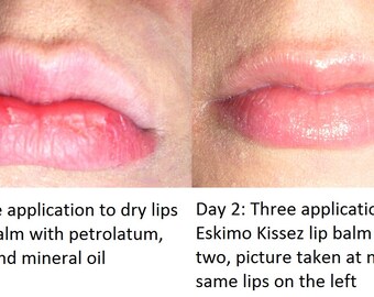 Thieves® Oil Type Lip Balm - Organic - Kills Germs - Antibacterial Lip Balm - Buy 4 Get 1 FREE