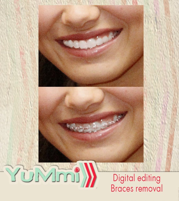 Items similar to Digital editing service braces removal