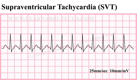 Image result for supraventricular tachycardia