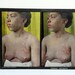Disturbing Photograph - Skin Disease Syphilis Circinata / Stereoview by Dr. S.I. Rainforth, Circa 1910