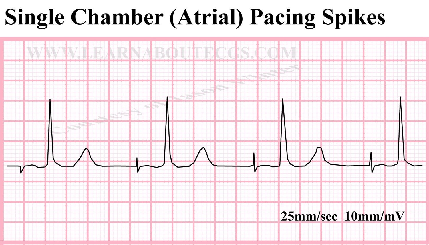 Single Chamber Atrial Pacing Spikes ECG by ELECTROCARDIOLOGY