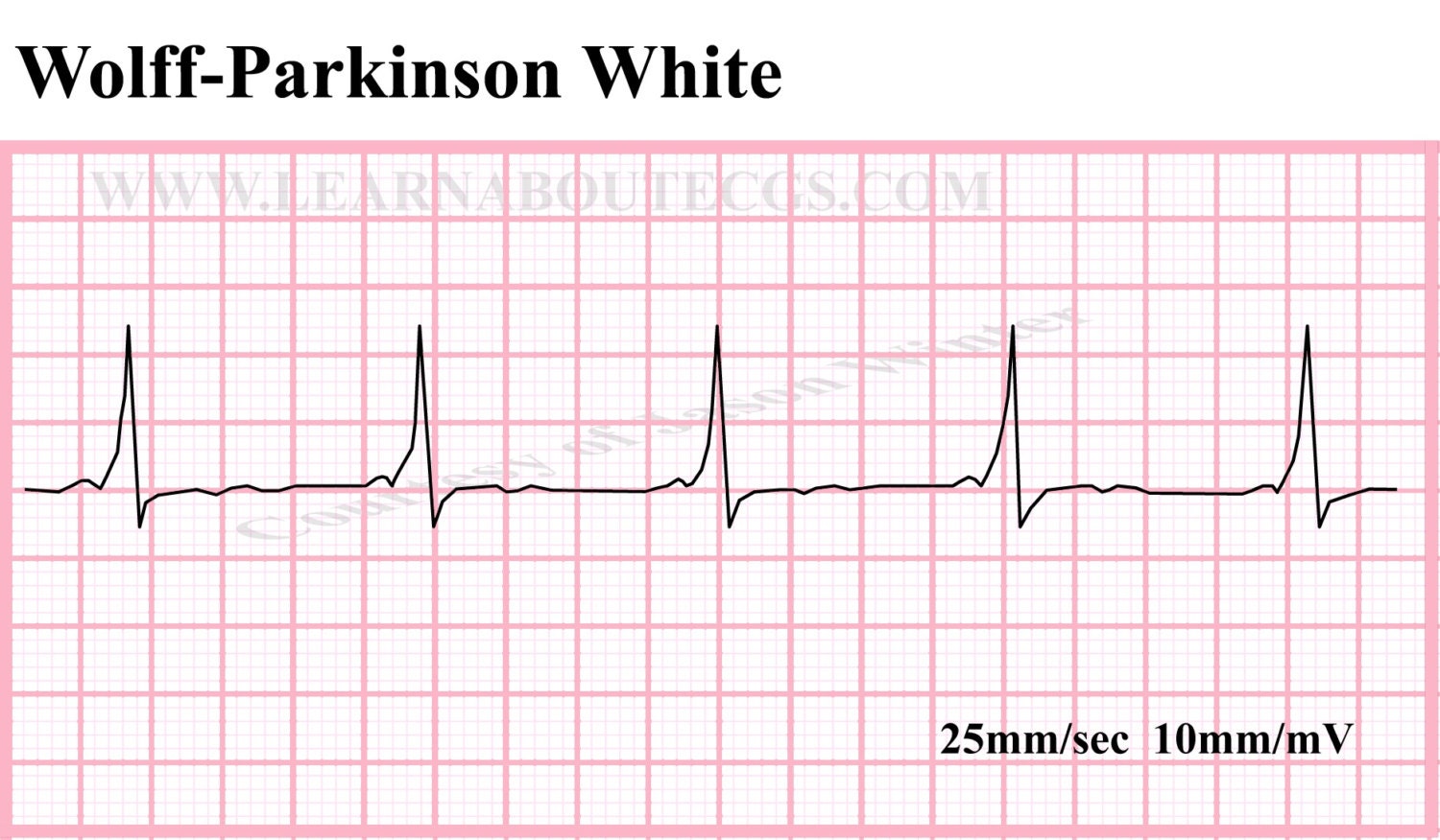 Wpw Ecg Rhythm Strip By Electrocardiology On Etsy