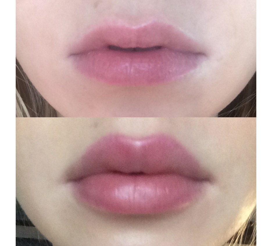 Lip Plumper. Lip plumping device.