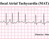 Items similar to Multifocal Atrial Tachycardia (MAT) ECG Strip on Etsy