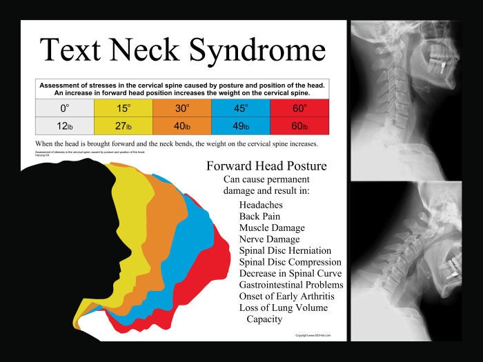 Text Neck Syndrome Poster 18 X 24