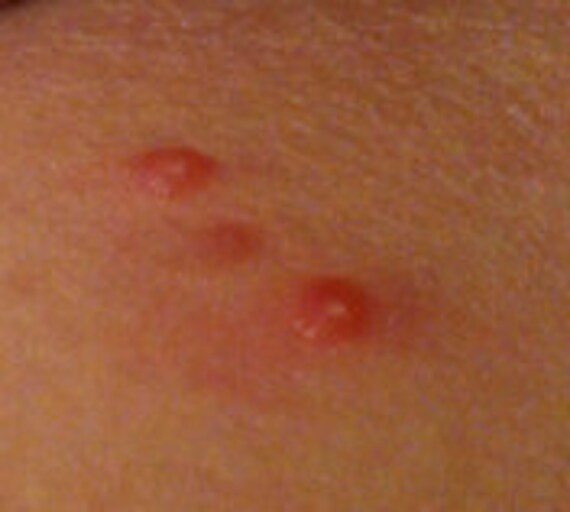 Family Molluscum Treat & Cure Guide