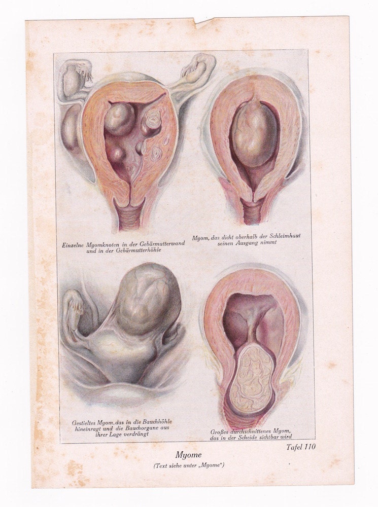 Uterus Disease Antique Medical Art Print 1920s German