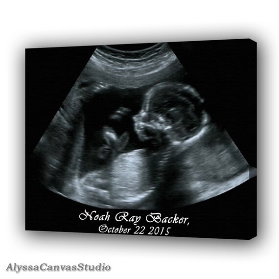 Ultrasound Image Canvas Sonogram Art Print Baby by AJCanvasPrints