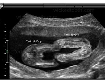 Fake 5-8 week twins Ultrasound/Sonogram/Gag by WickedTooth on Etsy