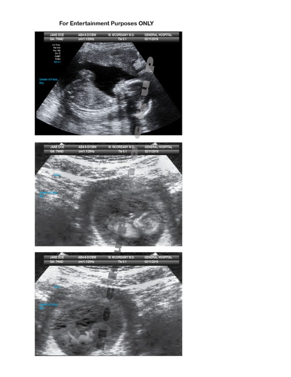 Emailed Prank 10-12 Wk Ultrasound 3 Different Images 2D