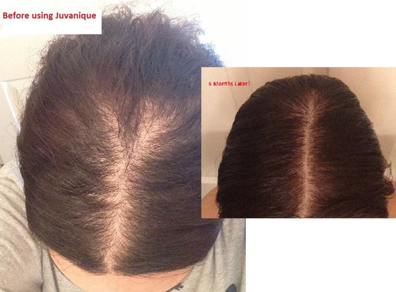 juvanique-reduces-hair-loss-promotes-new-hair-growth