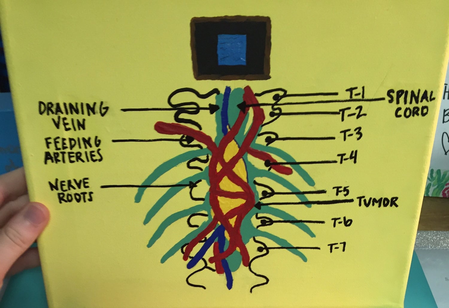 Grey's Anatomy Tumor on the Wall Canvas