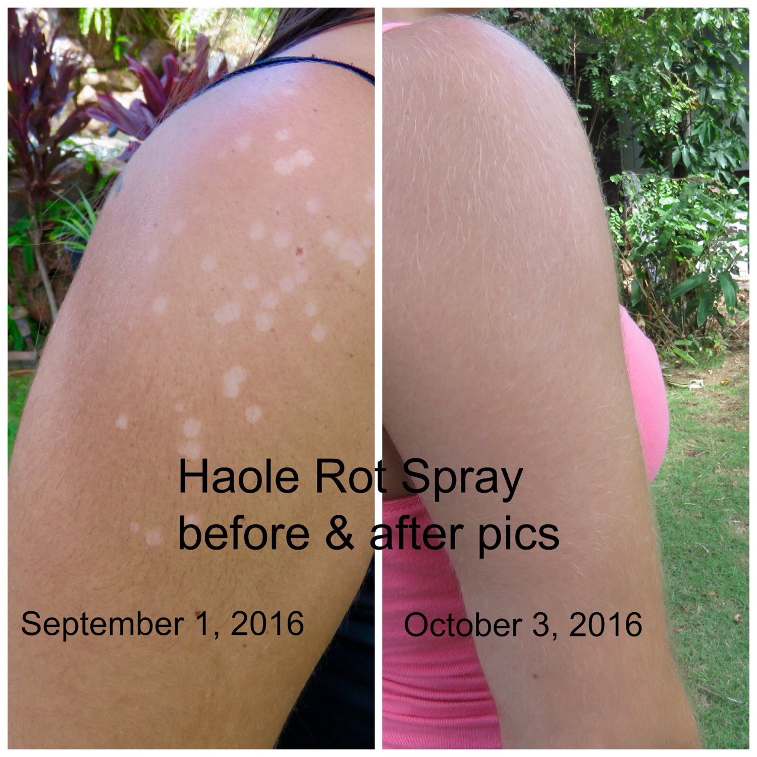 haole-rot-spray-tinea-versicolor-treatment-natural-tinea