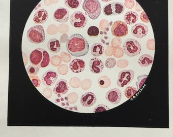 Myeloid leukemia blood smear 1940s vintage medical illustration