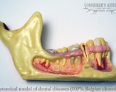 Chocolate Dental Disease
